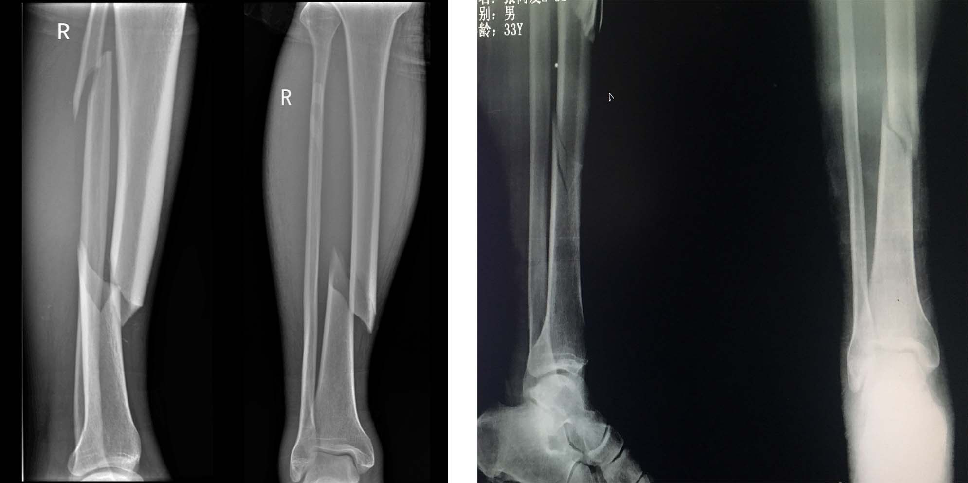 右小腿运动中胫腓骨闭合性骨折
